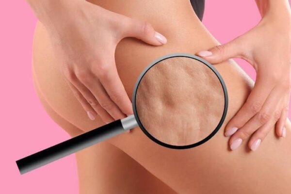 cellulite