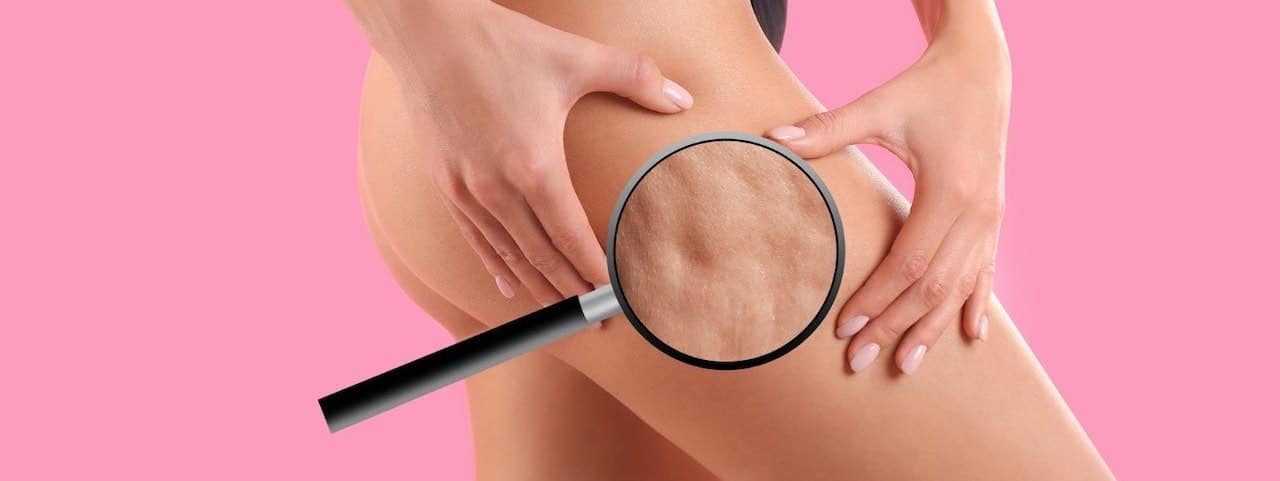 cellulite